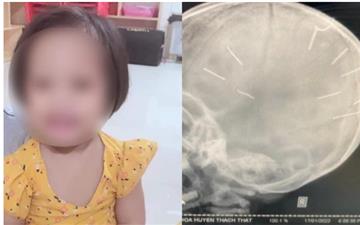 Bé gái 3 tuổi bị đinh găm vào đầu: Khi nào khởi tố vụ án?