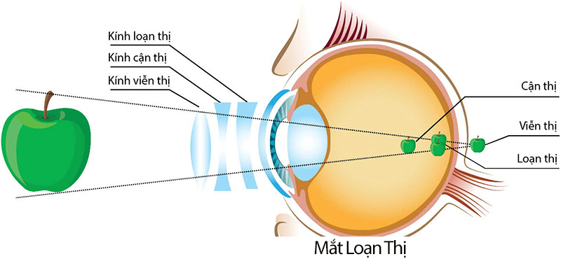 Loạn thị là gì? Loạn thị có bắt buộc đi nghĩa vụ quân sự không?