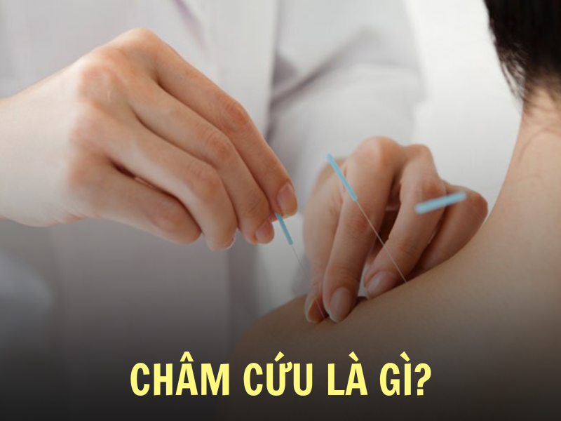 Châm cứu là gì?